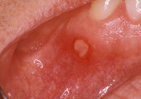 口腔溃疡症状图片3