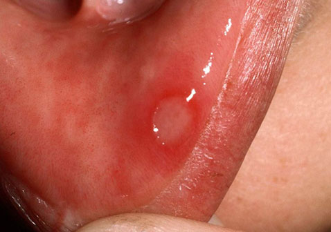 口腔溃疡嘴唇症状图片