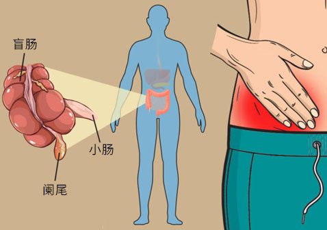 阑尾疼痛的位置图片