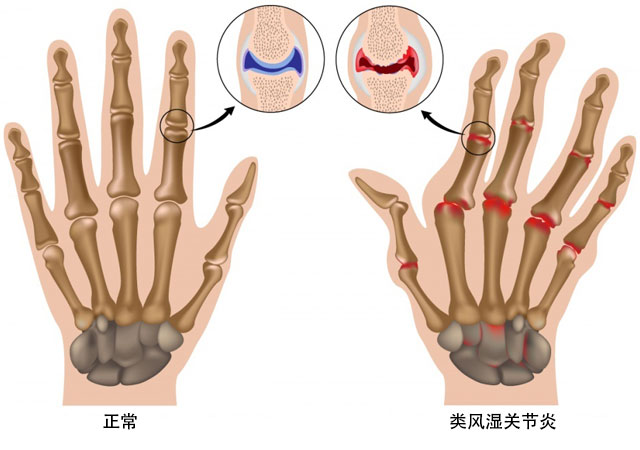 根治类风湿关节炎100%的偏方能治愈吗怎么治疗