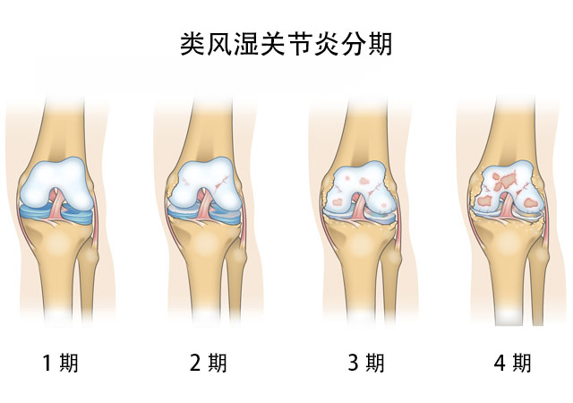 类风湿关节炎分期图片