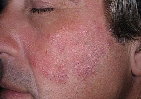 脸部牛皮肤癣初期症状图片