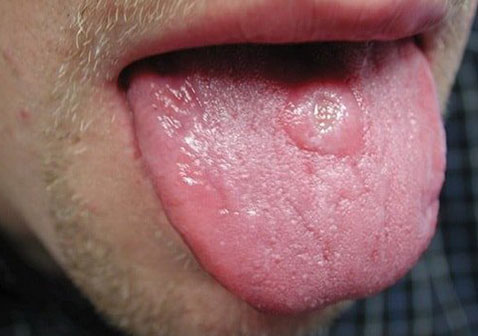 梅毒早期症状图片舌头上出现无痛溃疡
