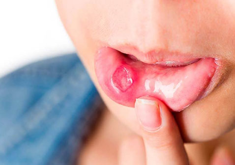 梅毒早期症状图片嘴唇无痛疮