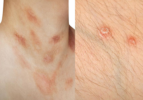 玫瑰糠疹和银屑病区别对比图片