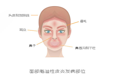 面部脂溢性皮炎发病部位图片