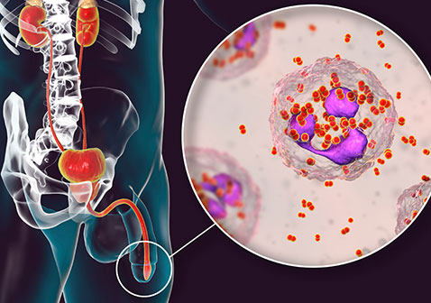 男性淋病图片