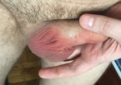 男性阴囊潮湿是什么原因怎么治疗疾病图片