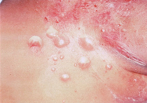 脓疱疮初期症状图片水泡形成