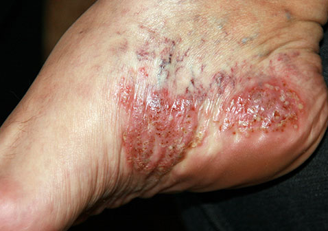 脚部脓疱型银屑病图片