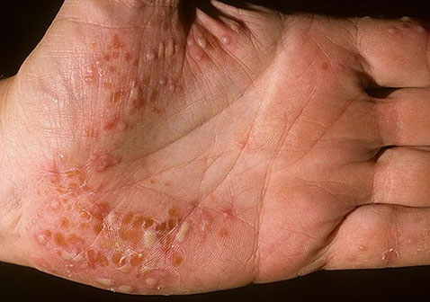 手掌脓疱型银屑病图片