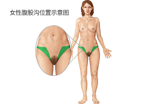 女性腹股沟位置图片