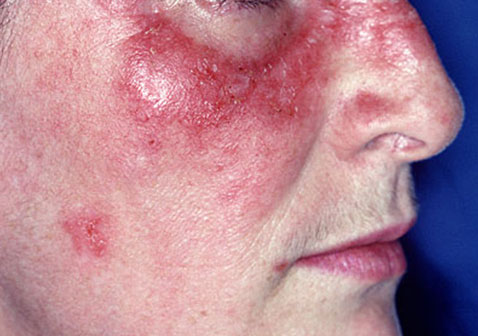 女性红斑狼疮早期症状面部皮疹图片