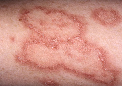 女性红斑狼疮早期症状盘状皮疹图片
