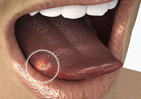女性红斑狼疮早期症状口腔溃疡图片
