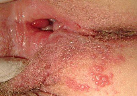 女性生殖器疱疹图片