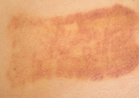 皮肤过敏症图片表现为接触性皮炎