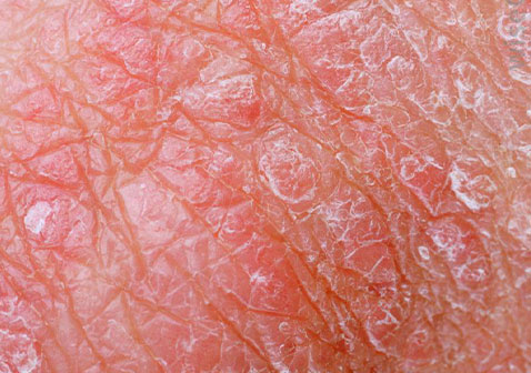 皮肤过敏10种症状图片3、4干燥鳞片