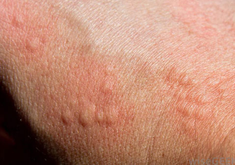 皮肤过敏症图片表现为荨麻疹