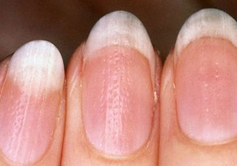 皮肤状况导致指甲盖凹凸不平图片