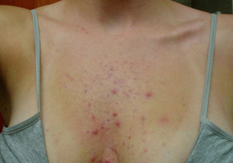 前胸痤疮症状图片
