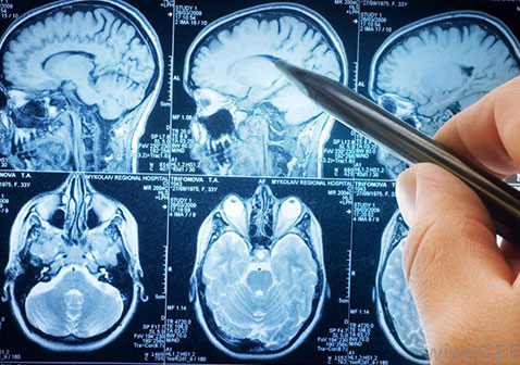 神经内科治疗什么图片脑肿瘤
