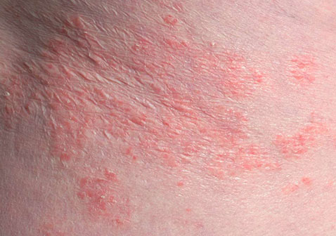 身上起红疙瘩越挠越痒皮肤发炎症状图片