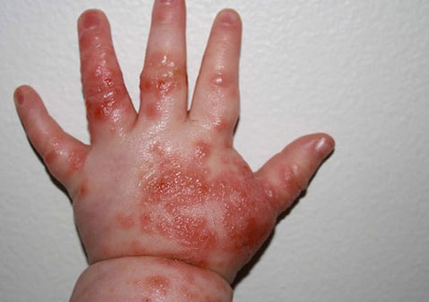 手背湿疹图片8