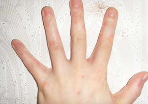 牛皮肤癣初期症状图片8粉红色斑点