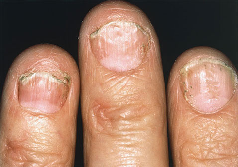 手牛皮癣症状图片影响到指甲