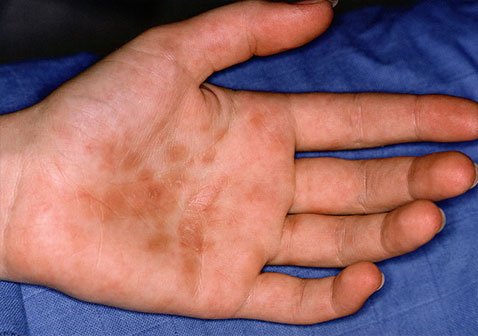 手脓疱型牛皮癣症状图片
