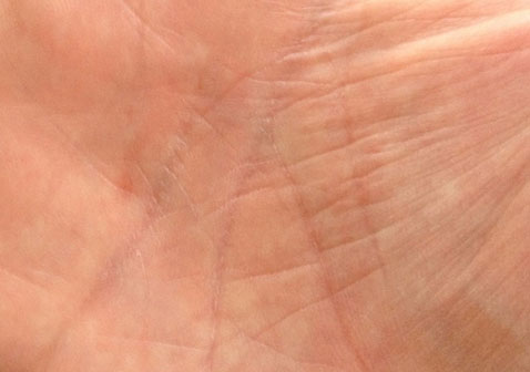 手掌牛皮癣初期症状图片