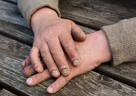 手指真菌感染症状图片