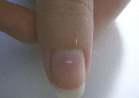 手指甲最轻微的白色浅表灰指甲图片