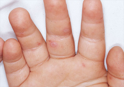 常见皮肤病图片及名称手足口病