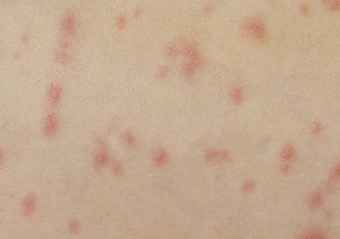 水痘第一天图片红色斑点