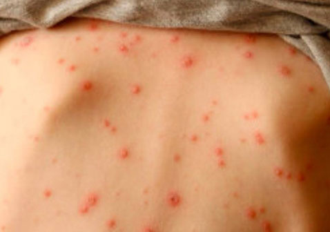 儿童9种常见的皮肤病图片水痘图片