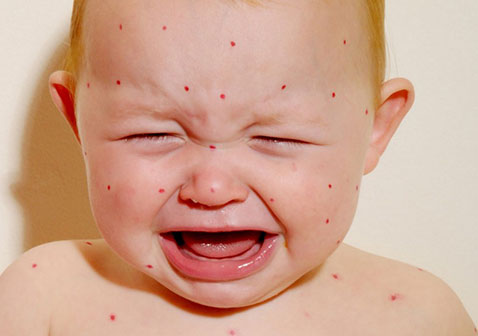 水痘图片通过打喷嚏或咳嗽传染