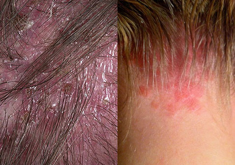 头部毛囊炎和银屑病的区别对比图片