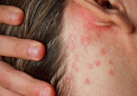 头皮牛皮肤癣初期症状图片红色斑点
