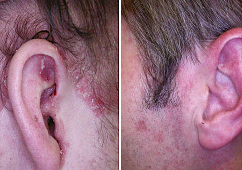 头皮银屑病和脂溢性皮炎的区别对比图片