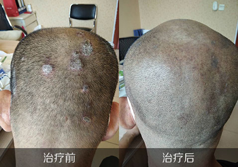头皮银屑病治疗前后对照图片