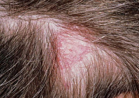 头皮真菌感染症状图片