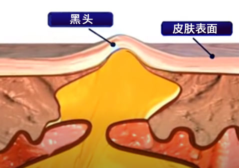 头上长疙瘩形成过程5皮肤凸起图片