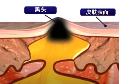 头上长疙瘩黑头形成图片