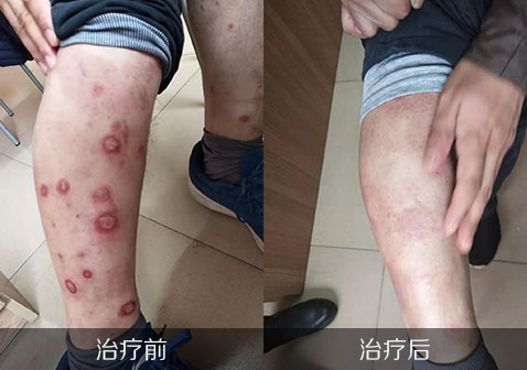 腿部银屑病治疗前后对照图片
