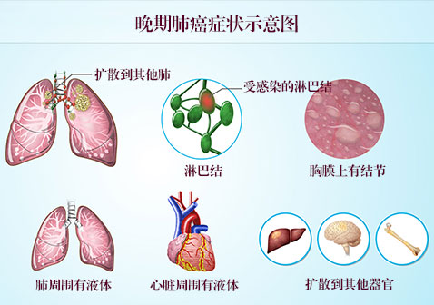 晚期肺癌症状图片