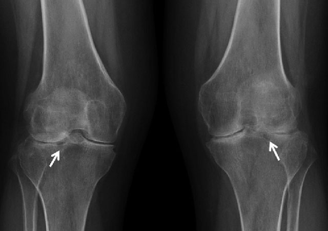 膝盖类风湿关节炎X光成像图片