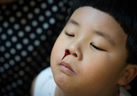 小孩流鼻血是什么原因图片