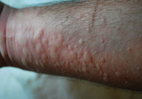 手臂上荨麻疹图片和症状疙瘩